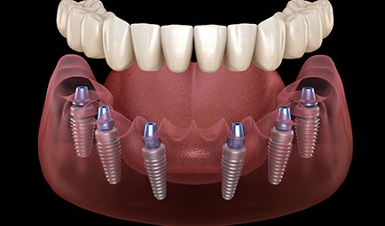 Six dental implants and denture in Baltimore
