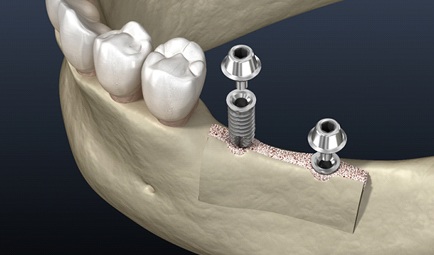 Two dental implants being inserted into alveolar ridge