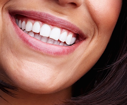 Woman's flawless smile after porcelain veneers