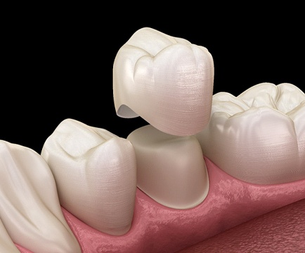 3D model of a dental crown capping a prepared tooth