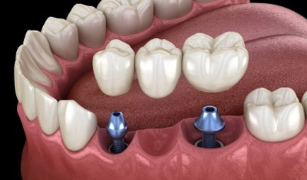 Aniamted dental implant supported fixed bridge placement