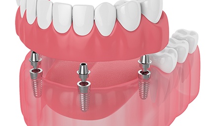 Digital illustration of dental implant denture in Baltimore