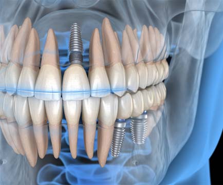 Illustration of dental implants, a common part of full mouth reconstruction