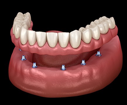 A 3D illustration of implant dentures