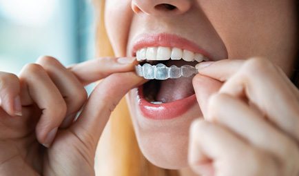 Woman taking off Invisalign aligners