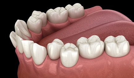 Illustration of crooked teeth