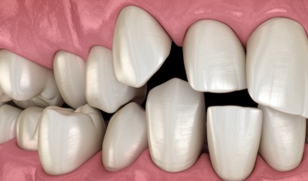 Illustration of spaced-out teeth