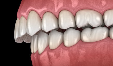 Illustration of an overbite